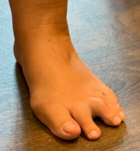 What is Morton's Neuroma?