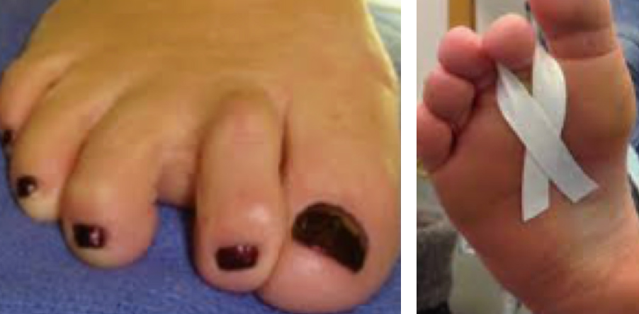 b12 injection for morton's neuroma Cortisone Mortons Neuroma Injection - WikiSM