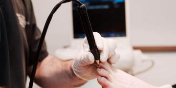 Case Study: Cryosurgery for Stump Neuroma