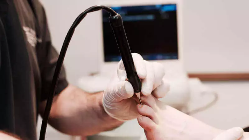 Cryosurgery for Morton's Neuroma