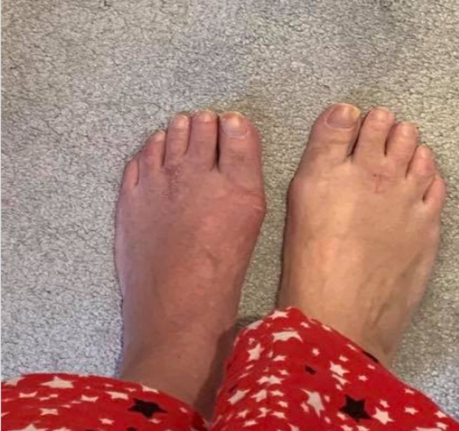 CRPS