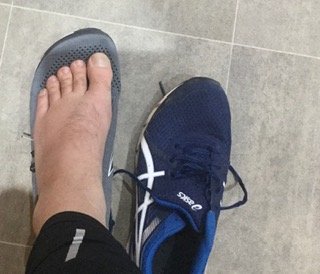 intermetatarsal bursitis