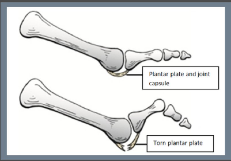 What happens when a plantar plate tears?