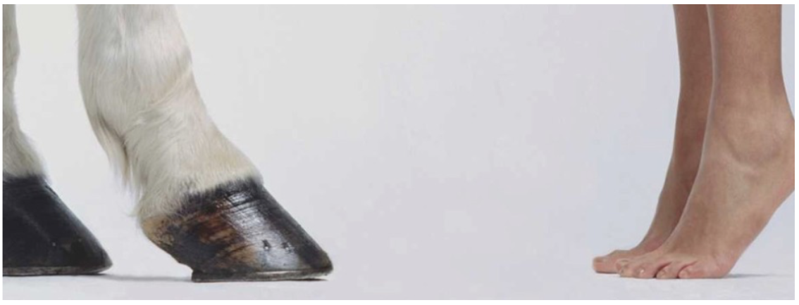Morton's Neuroma Ankle